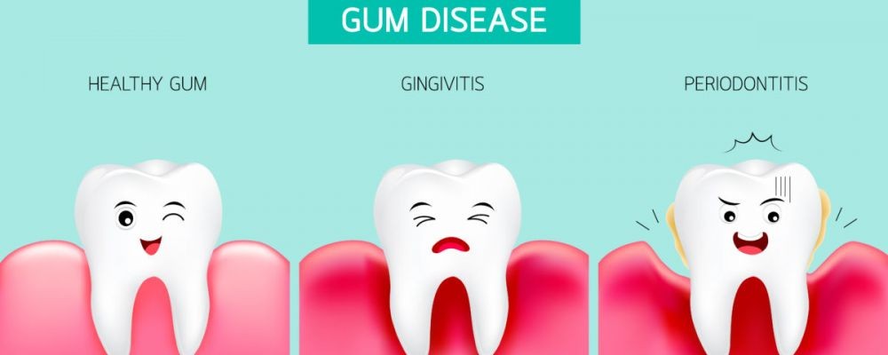 Ilustrasi perbandingan gusi sehat dan tidak sehat. Sumber: Westoldsdental.co