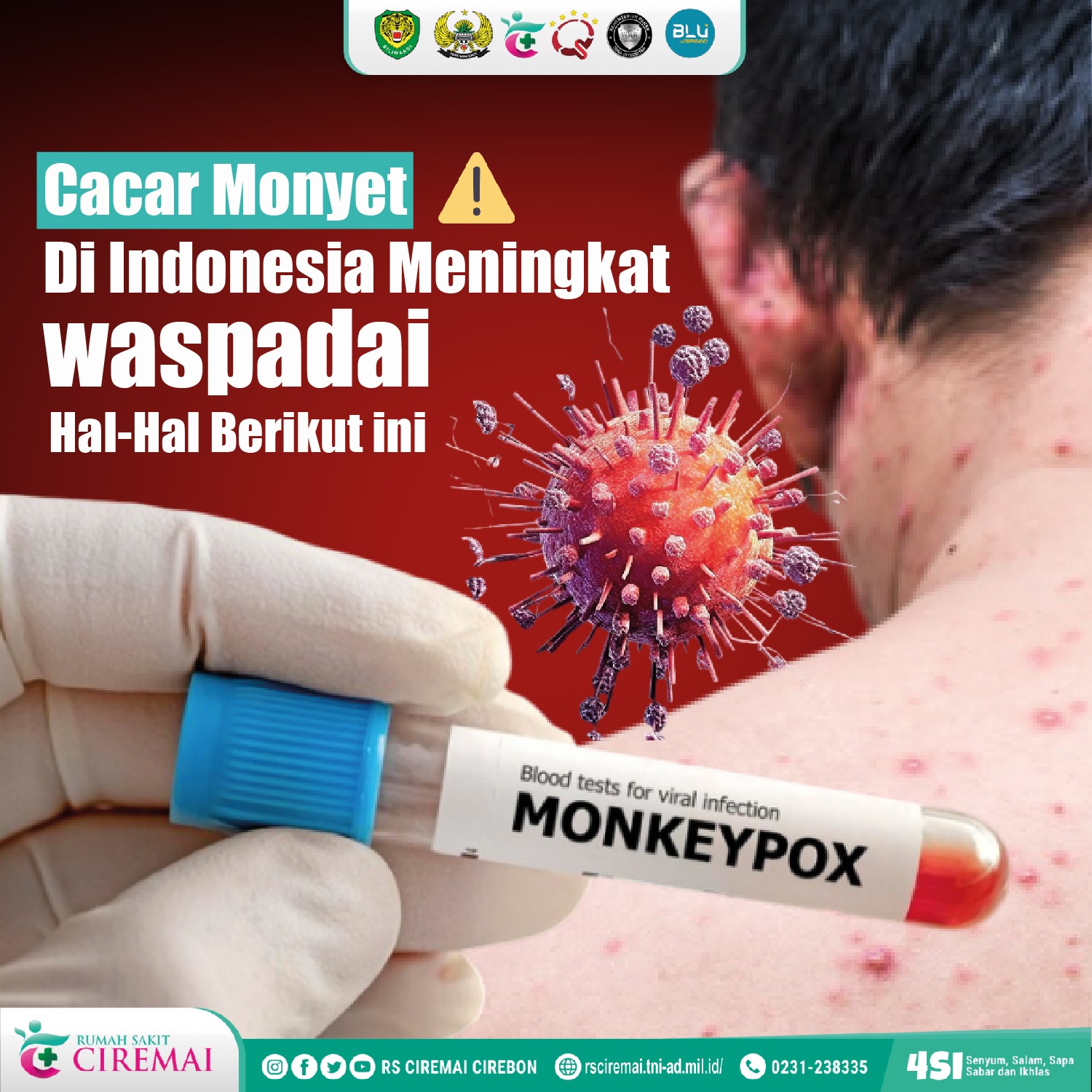 Cacar Monyet di Indonesia Meningkat, Waspadai Hal-Hal Berikut ini